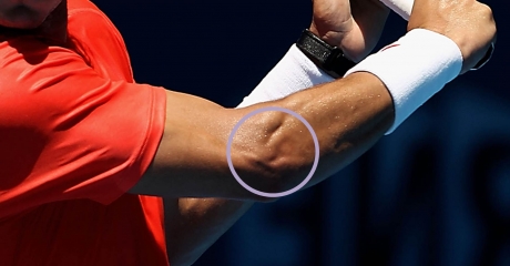 Sepa sobre una de las lesiones más frecuentes en el tenis: Epicondilitis o “codo de tenista”